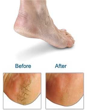 Foot Heel Repair Cream Dry Hard Skin Feet Cracked Heels  